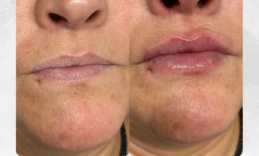 Image 5: Up to 25% Off on Facial - Anti-Ageing at Tranquil Aesthetics