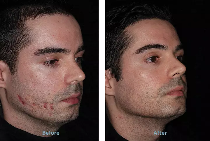 Up to 62% Off on Laser Skin Resurfacing at Vibe Med Spas - Primary Image