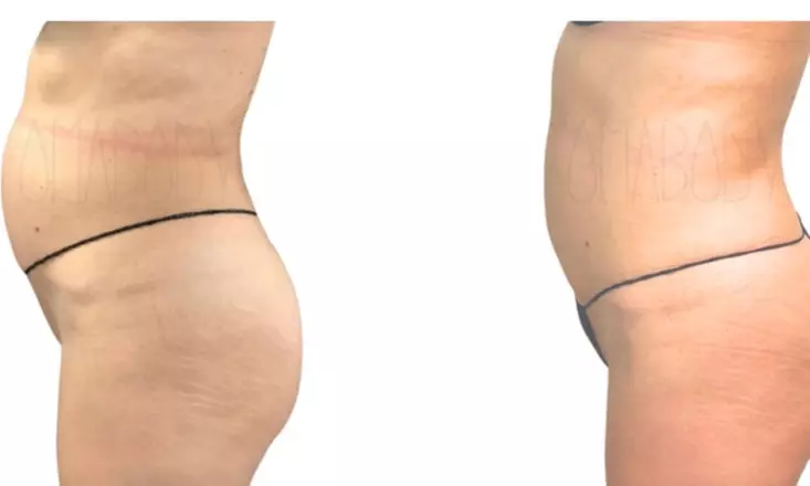 Transform your body with OmaBody's Belly Blaster & Cellulite Smoothing Package, featuring non-branded fat reduction, up to 50% off. - Primary Image