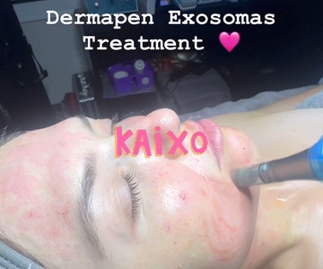 Microneedles Exosomes Face and Neck - Kaixo Spa