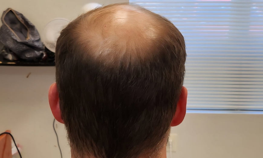 Image 3: $369 or $265 Worth of Non Surgical Hair Replacement