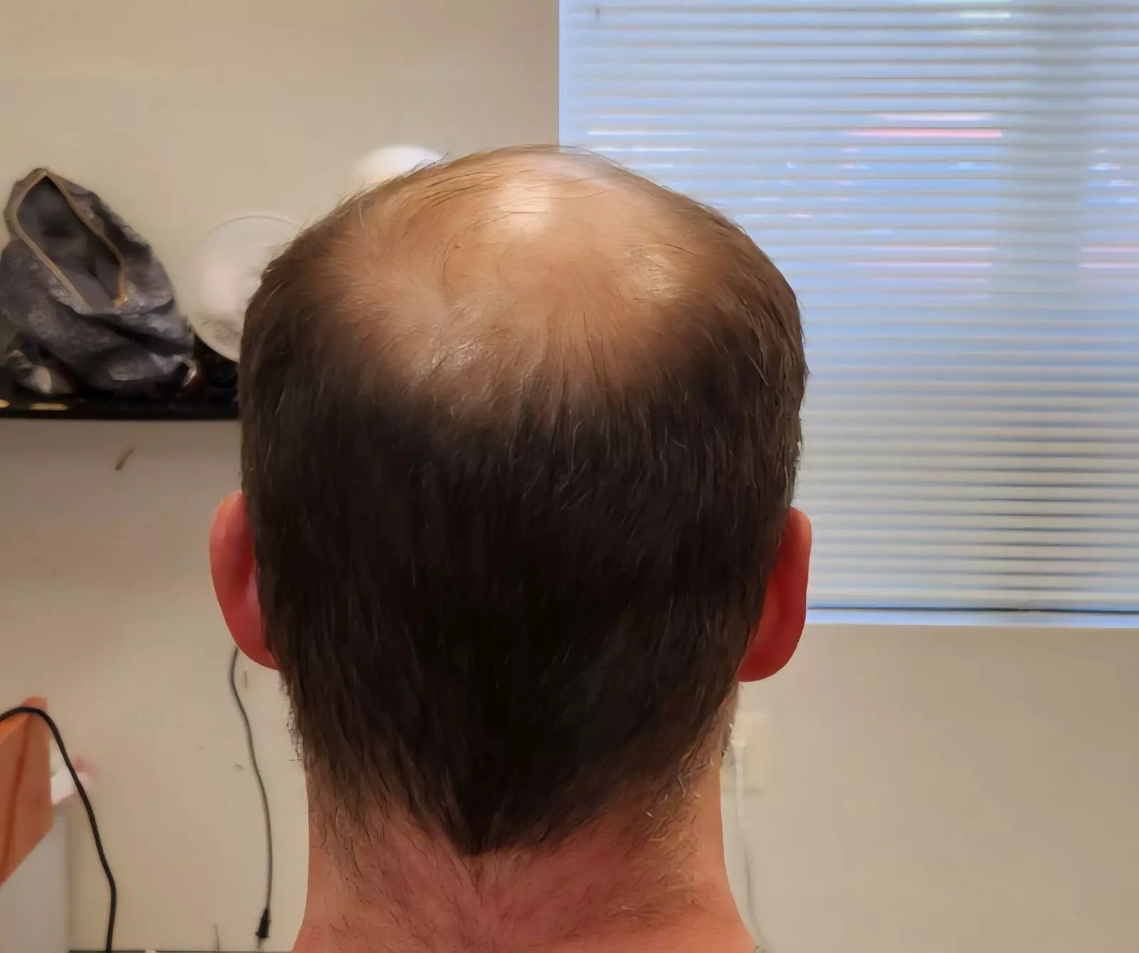 $369 or $265 Worth of Non Surgical Hair Replacement
