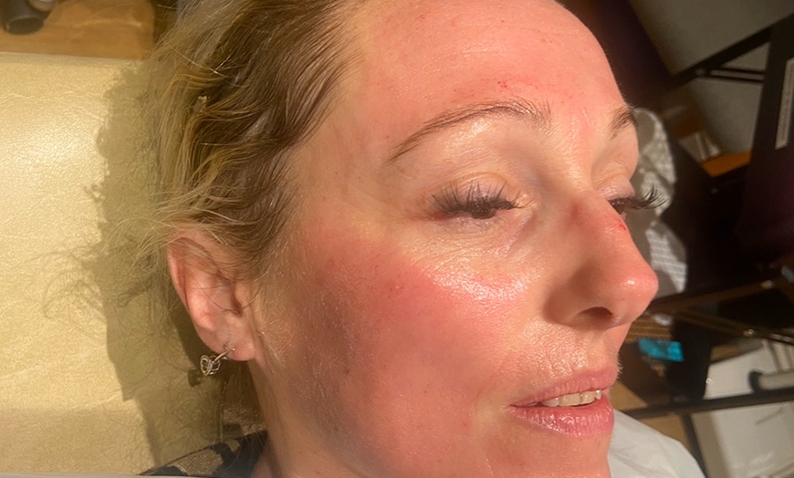 Image 4: Smooth Skin with 1 or 3 Micro-needling session w/ Hyaluronic acid
 