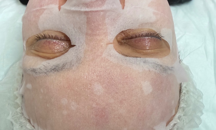 Image 7: One or Two Microneedling Treatments with Hyaluornic Acid and More