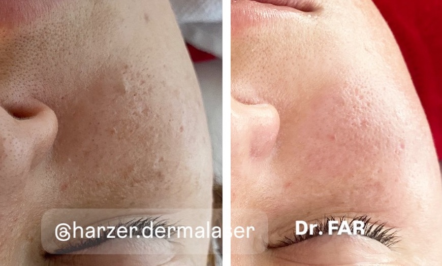 Image 4: Enzym-Hauterneuerung & Serum-Therapie, optional mit Microneedling