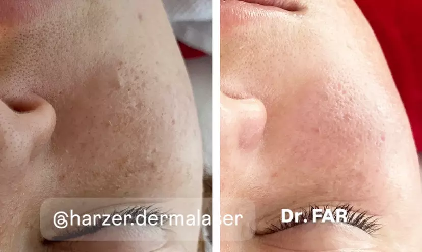 Enzym-Hauterneuerung & Serum-Therapie, optional mit Microneedling