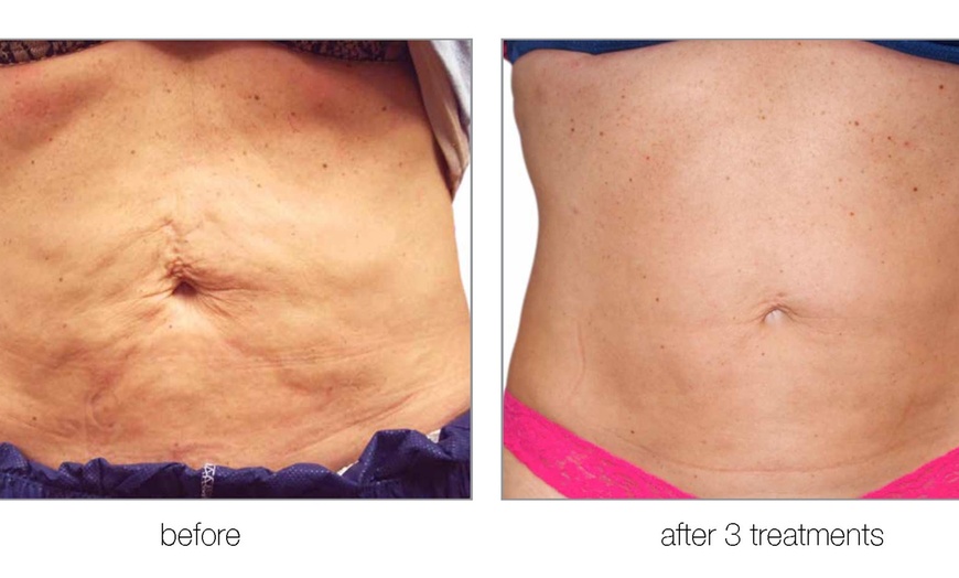 Image 2: Up to 76% Off on RF Body Contouring at 4D Skin Care Clinic