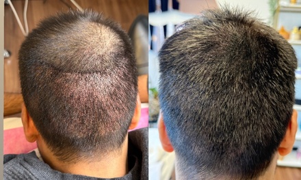 Scalp Micropimentation(SMP) - Roya pmu beauty