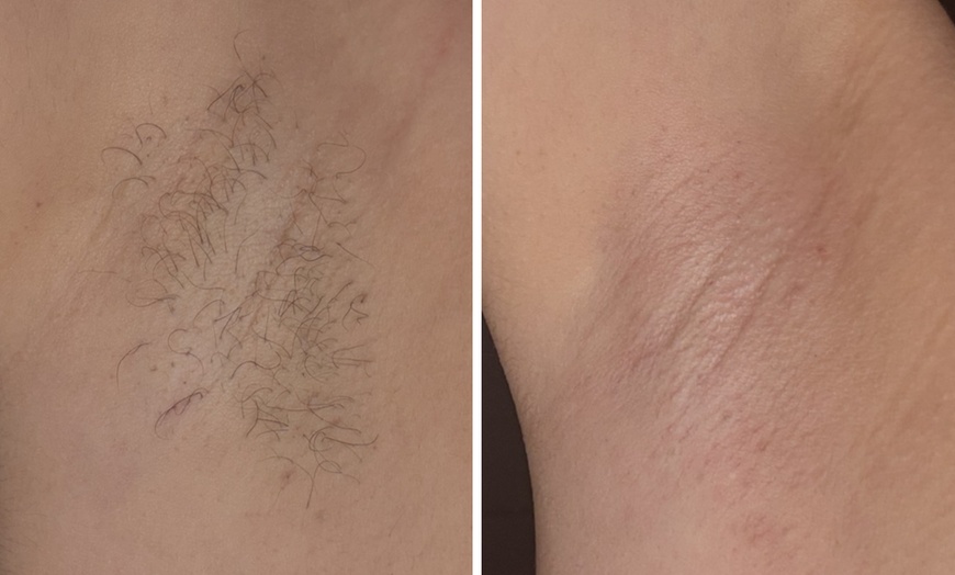 Image 2: Brazilian & Underarm Waxing with Aftercare Kit or  Two Underarm Waxes