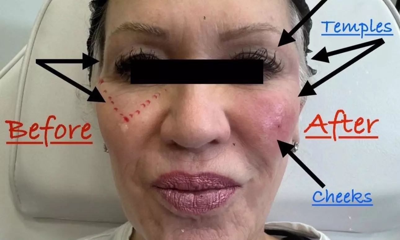 PRF -Liquid for Under Eyes / Organic Filler / PRF- EZ Gel