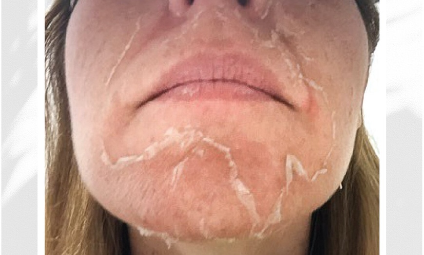 Image 1: Refresh Skin with Vi Peels at Aesthetix Lab Dana Point  