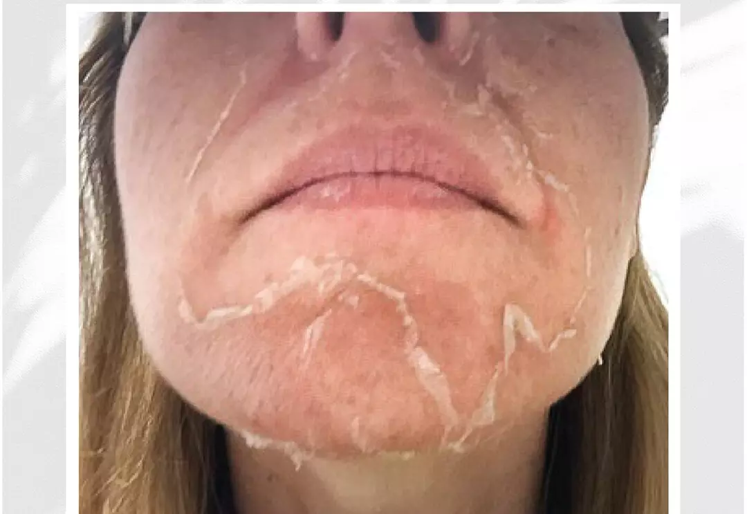 Refresh Skin with Vi Peels at Aesthetix Lab Dana Point