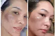 Rejuvenate with Procell Therapies: Face & Neck or Stretch Marks & More (Up to 37% Off) at Nouveau Toi Med Spa - Second Medium