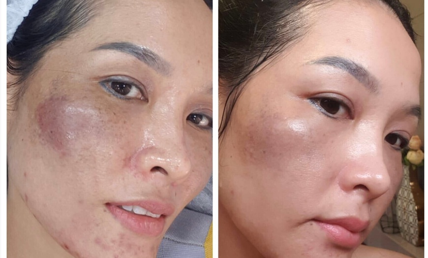 Image 2: Rejuvenate: Procell Therapies: Face & Neck or Stretch Marks & More