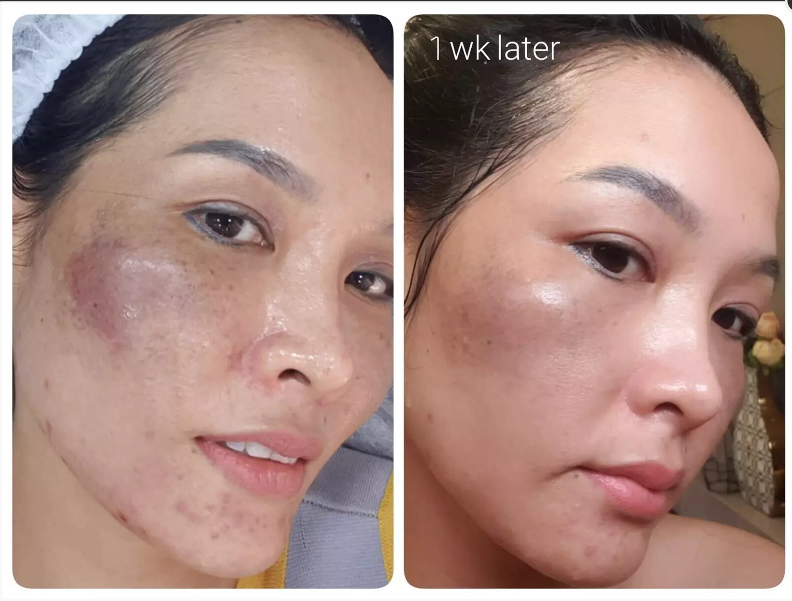 Rejuvenate: Procell Therapies: Face & Neck or Stretch Marks & More