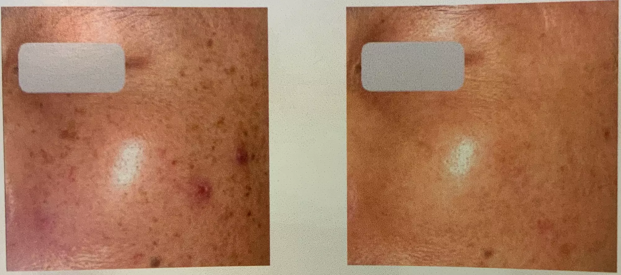 3 or 5 Photorejuvenation Sessions: Full Face w/ or w/o Neck