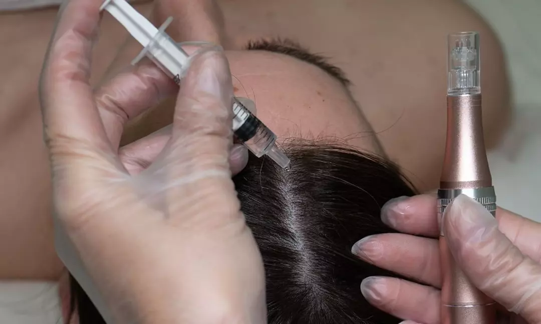 Up to 40% Off on Hair Restoration - Non-Surgical at Benefit Aesthetics