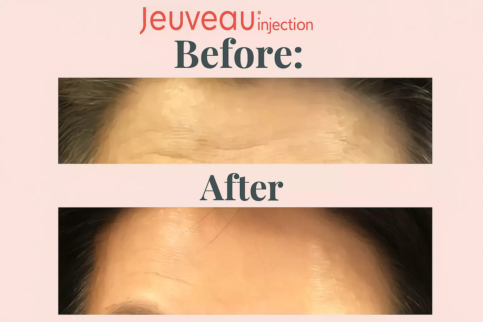 20, 40, or 60 Units of Jeuveau by Evolus (#newtox-comparable to Botox)