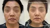 Up to 64% Off on Ultherapy / Ultrasonic Facial at One Beauty Aesthetics