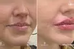Up to 65% Off on Injection - Dermal Filler at One Beauty Aesthetics - Second Medium