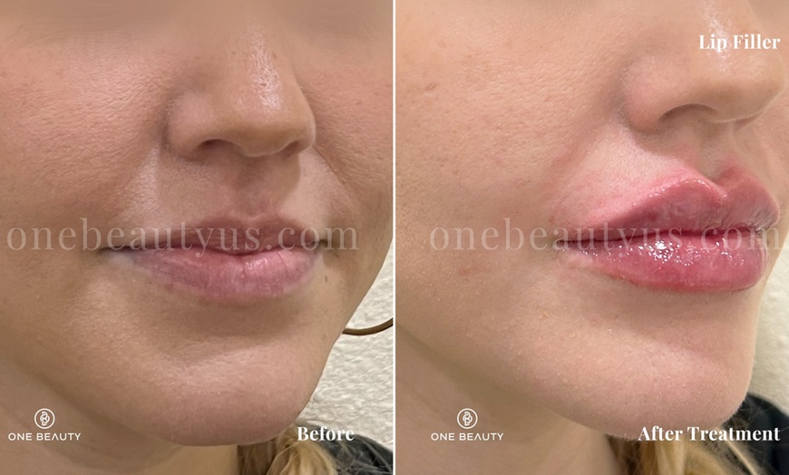 Image 4: Up to 52% Off on Injection - Dermal Filler at One Beauty Aesthetics