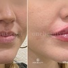 Image 4: Up to 52% Off on Injection - Dermal Filler at One Beauty Aesthetics