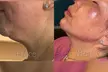 Up to 46% Off on Juvederm Injection - at PMU MD Aesthetics (Virtual Consultation Required) - Second Medium