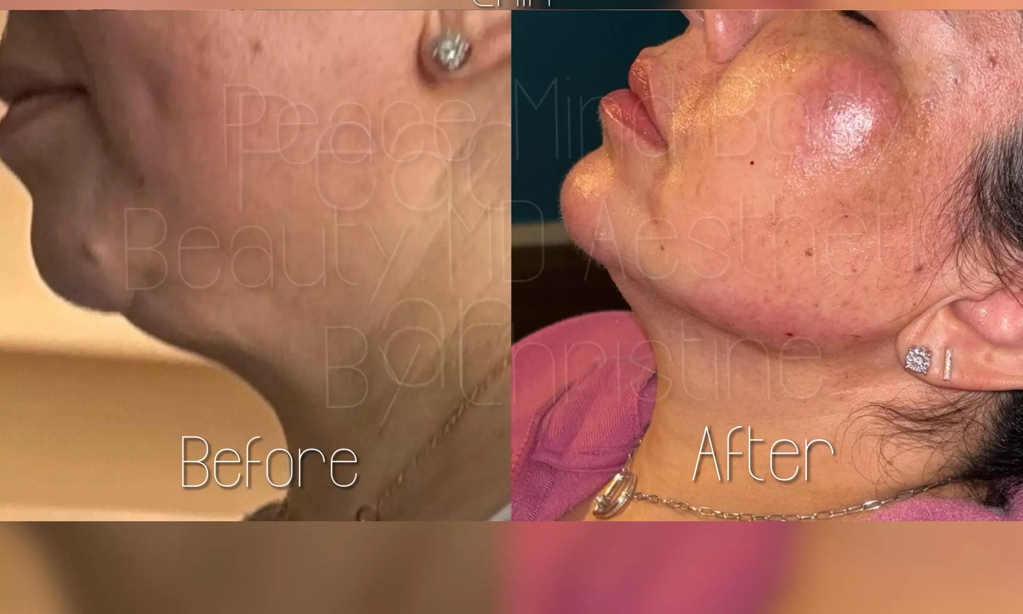 Up to 45% Off on Injection - Juvederm Filler 