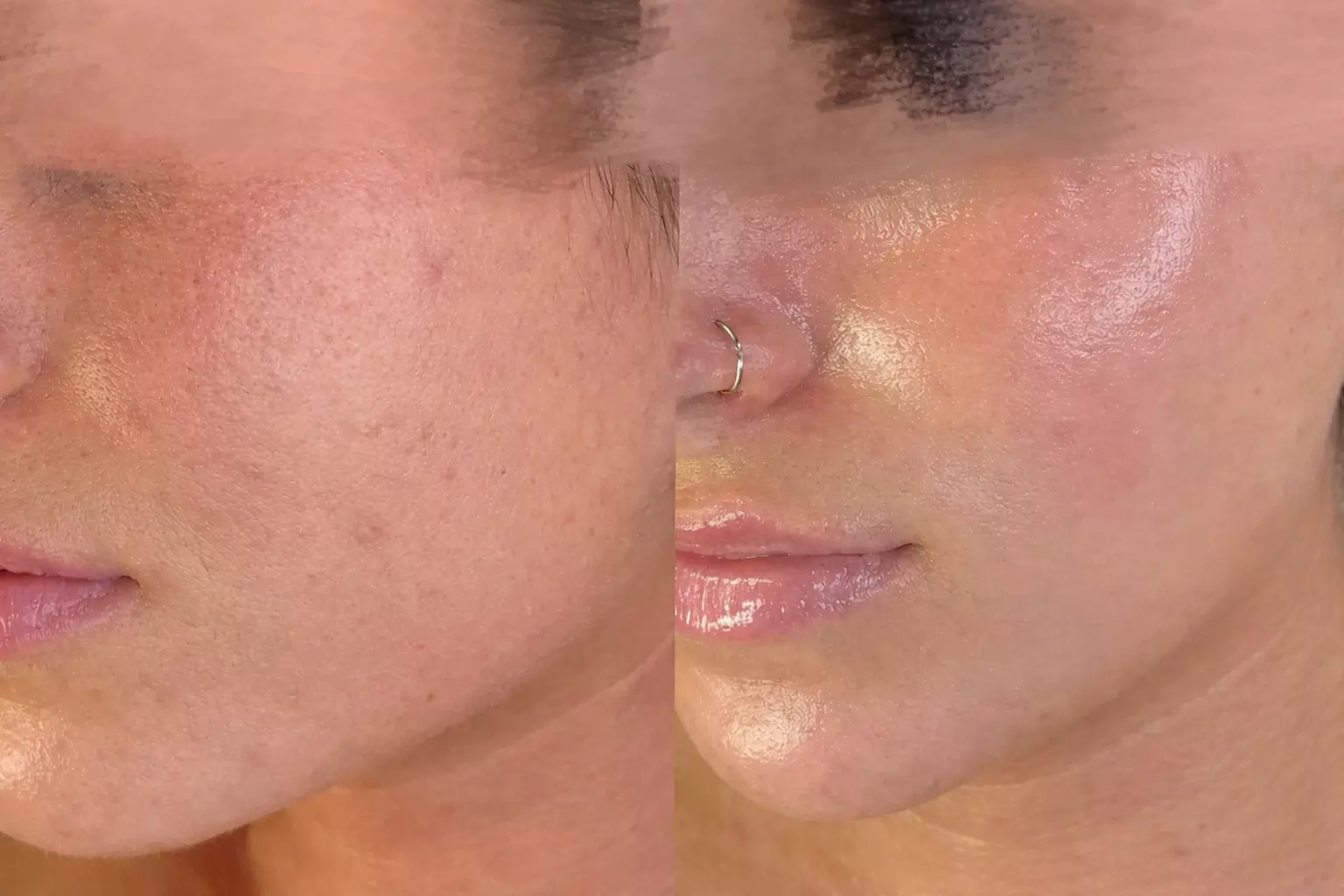1 or 3 IPL Acne, Melasma, Brown Spots, or Rejuvenation Treatments