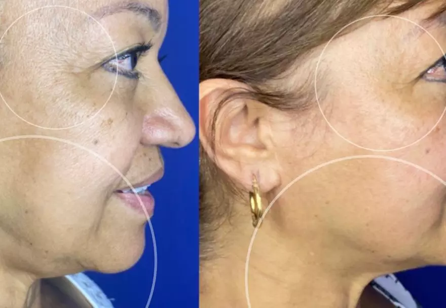 Up to 51% Off on Plasma Fibroblast Session at Beauty spa by val - Second Medium