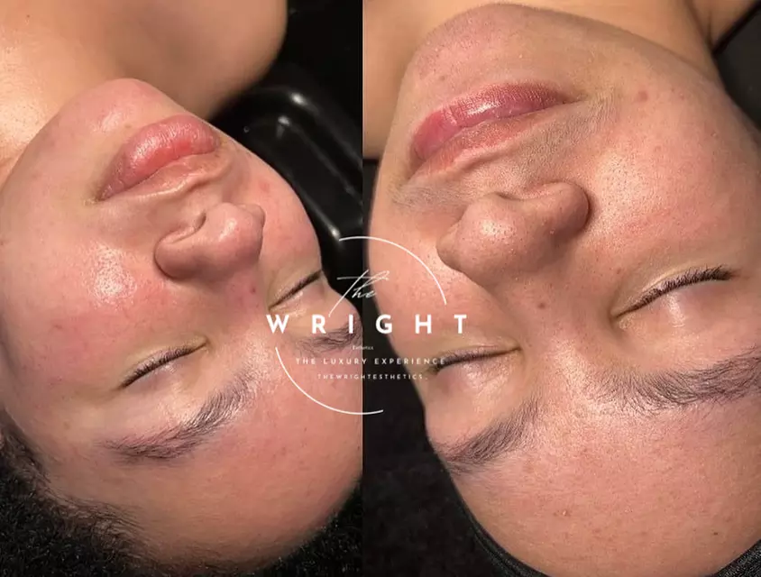 Experience rejuvenating in spa facials at The Wright Esthetics with options for up to 49% off.