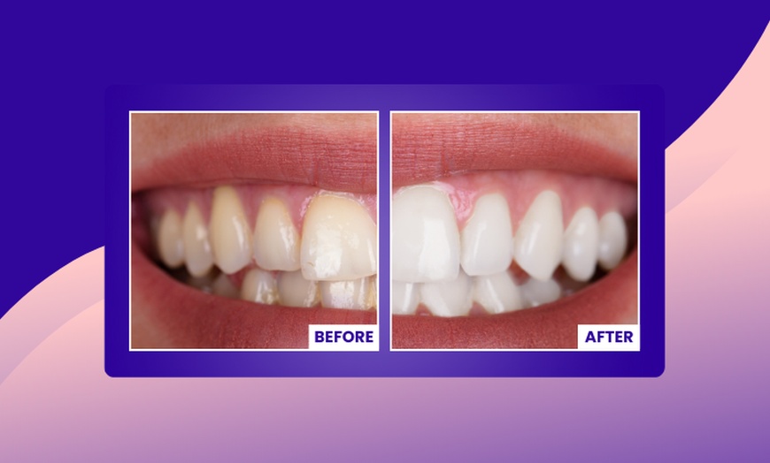 Image 1: Transform Your Smile with Custom Teeth Whitening
