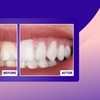 Image 1: Transform Your Smile with Custom Teeth Whitening