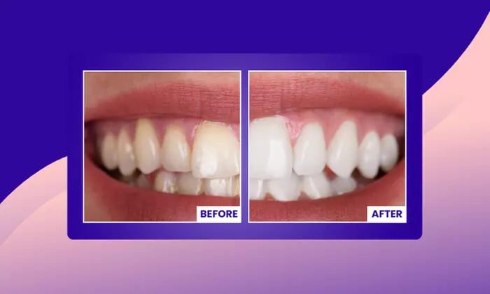Transform Your Smile with Custom Teeth Whitening