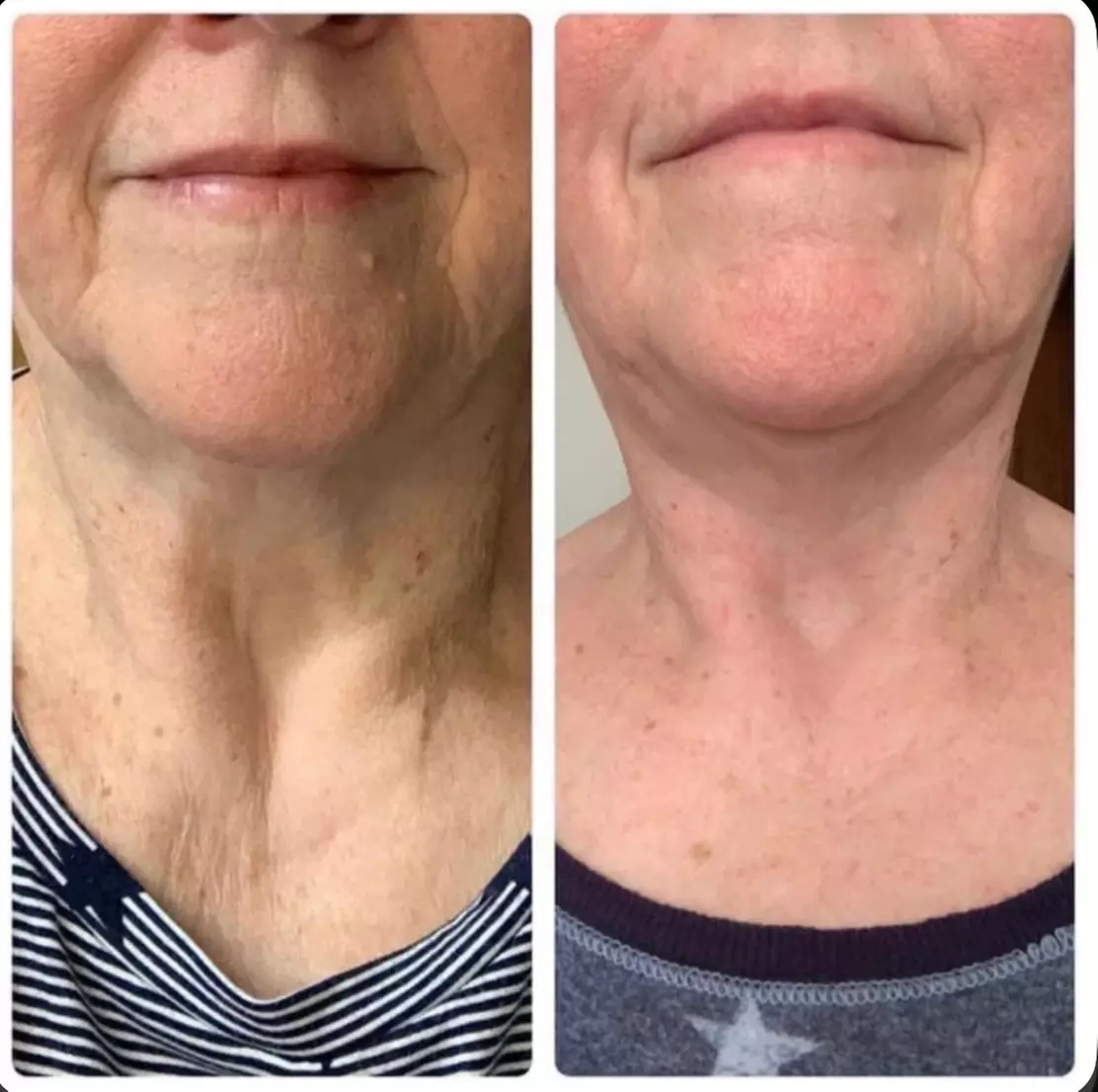 3 o 6 sesiones de lipoláser, radiofrecuencia y presoterapia