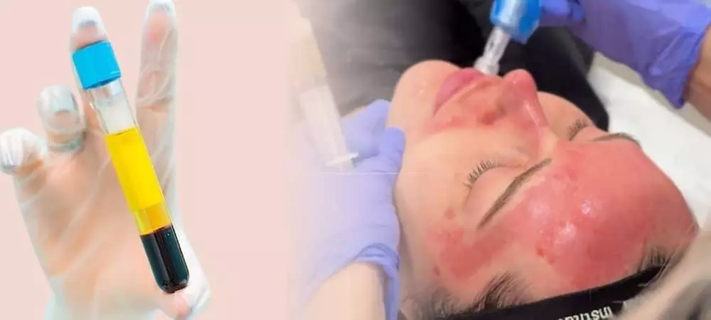 Up to 50% Off PRP Facial with Advanced Microneedling Treatment at Time for You - Primary Image