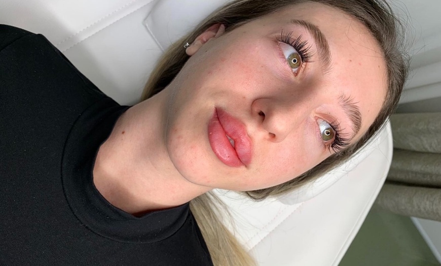 Image 1: 0.55 ml or 1 ml Lip Dermal Filler at Queen of Lips with 2 locations