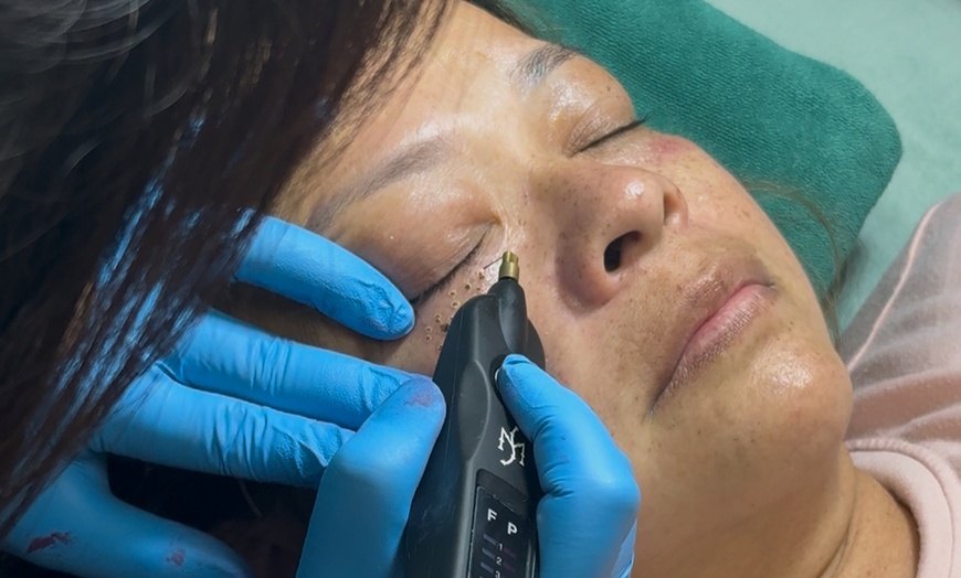 Image 1: Up to 69% Off on Injection - Plasma at Hang's Spa