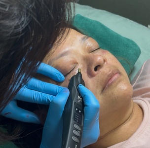 Plasma removal callus corn ,dark spots  - Hang's Spa
