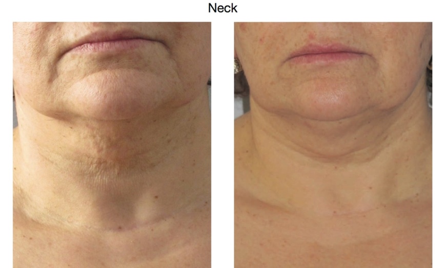 Image 2: Up to 60% Off on Radio Frequency Skin Tightening at Sculpting Beauty by Pam