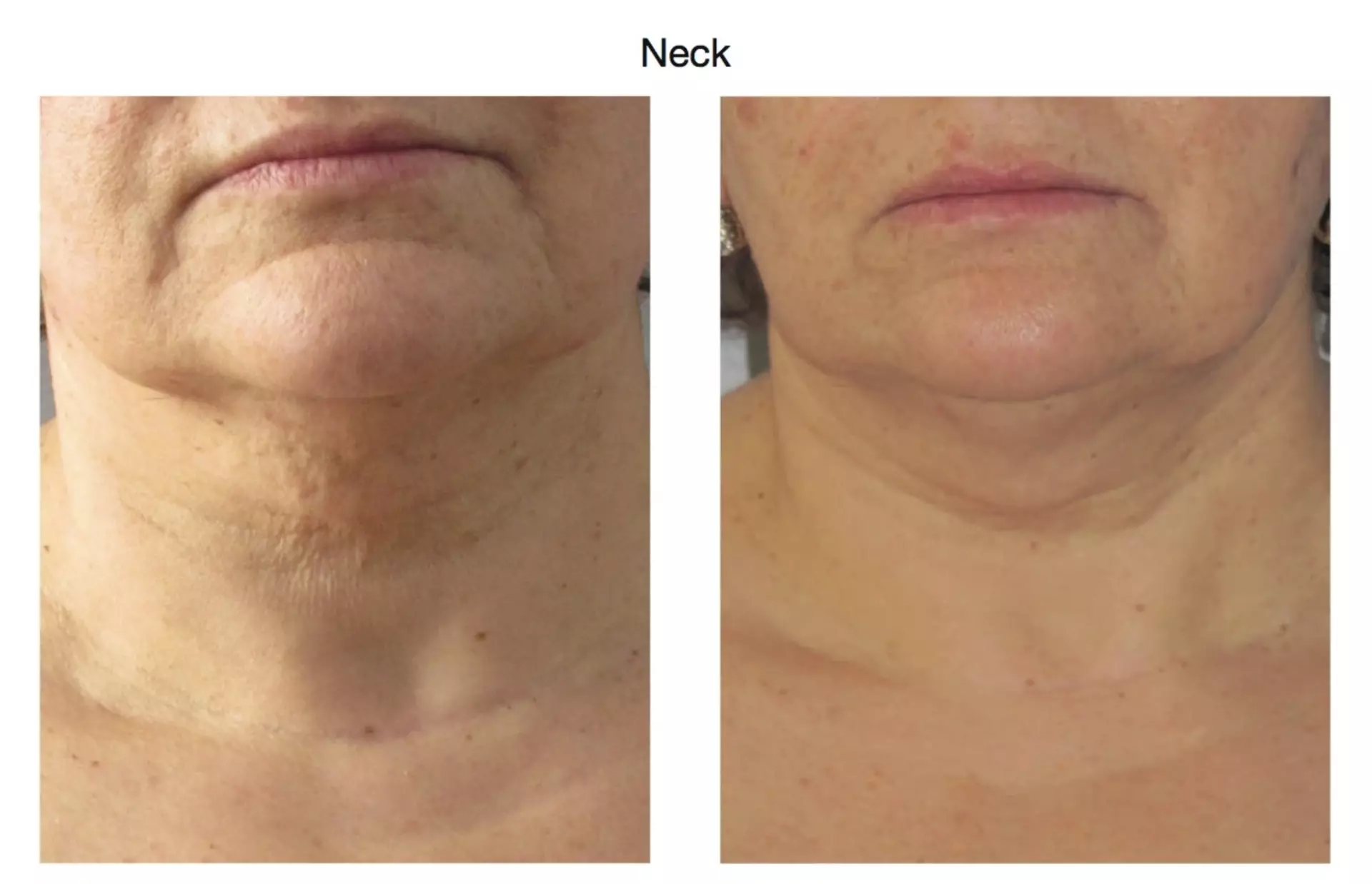 Up to 60% Off on Radio Frequency Skin Tightening at Sculpting Beauty by Pam - Second Medium