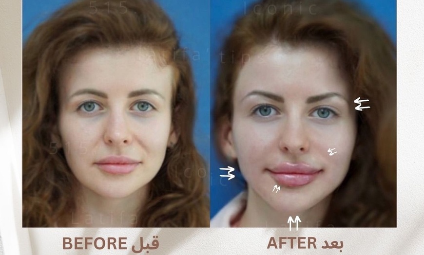 Image 12: Achieve a Natural Look with Dermal Filler 0.5ml, 1ml, or 2ml