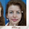 Image 12: Achieve a Natural Look with Dermal Filler 0.5ml, 1ml, or 2ml