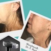 Image 3: Up to 30% Off on Facelift - Non-Surgical at iGlow Aesthetics