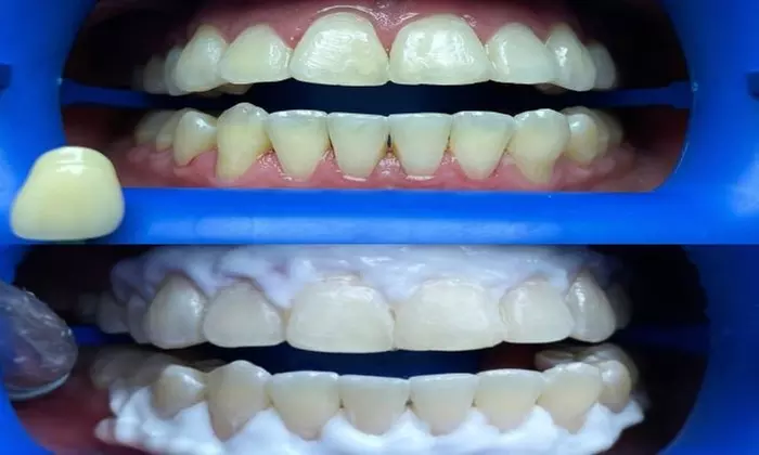 Up to 30% Off on Teeth Whitening - In-Office - Branded (Zoom, Brite Smile) at MADWHITE Mobile - Second Medium