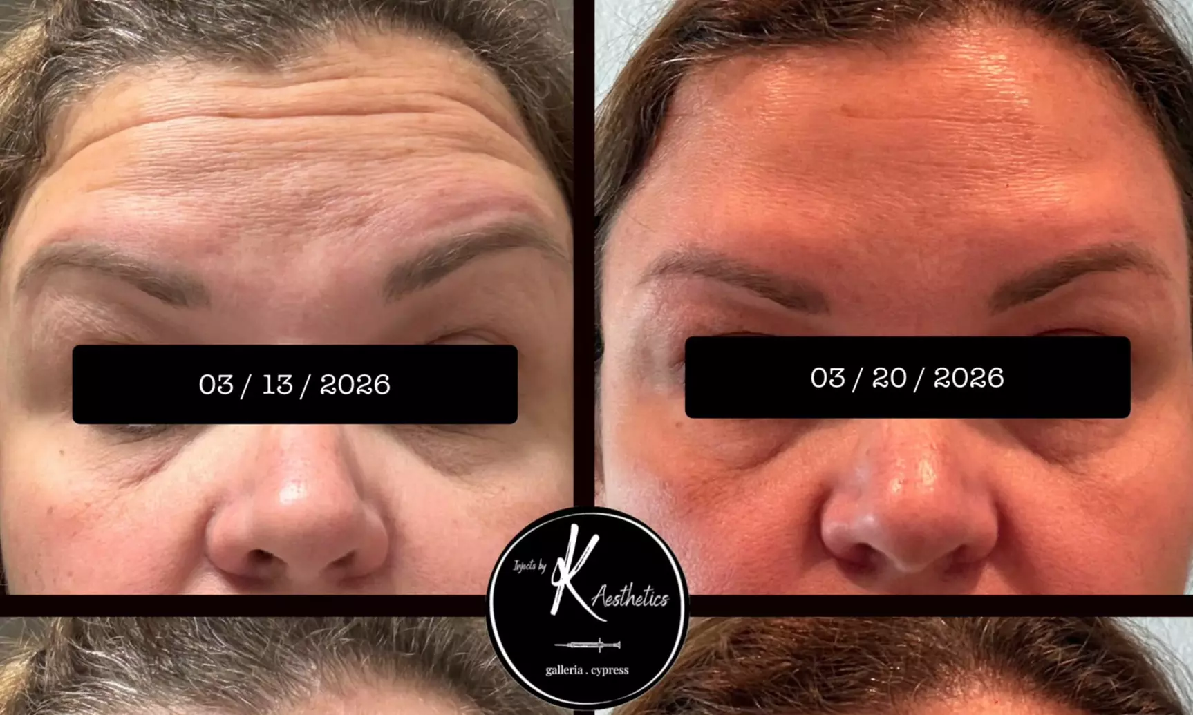 Long-lasting Daxxify Treatments for a Flawlessly Smooth Look at Injects by K