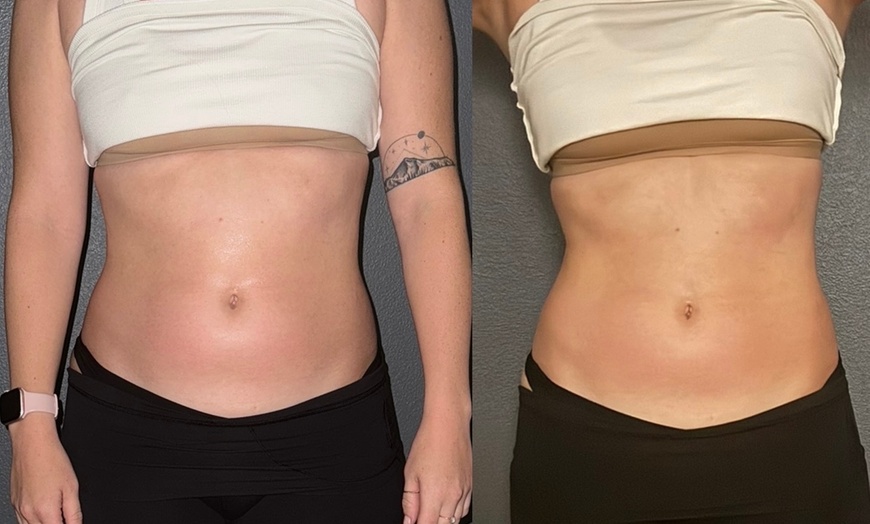 Image 2: Up to 30% Off on Ultrasonic Fat Reduction at AZ Esthetics and Head Spa