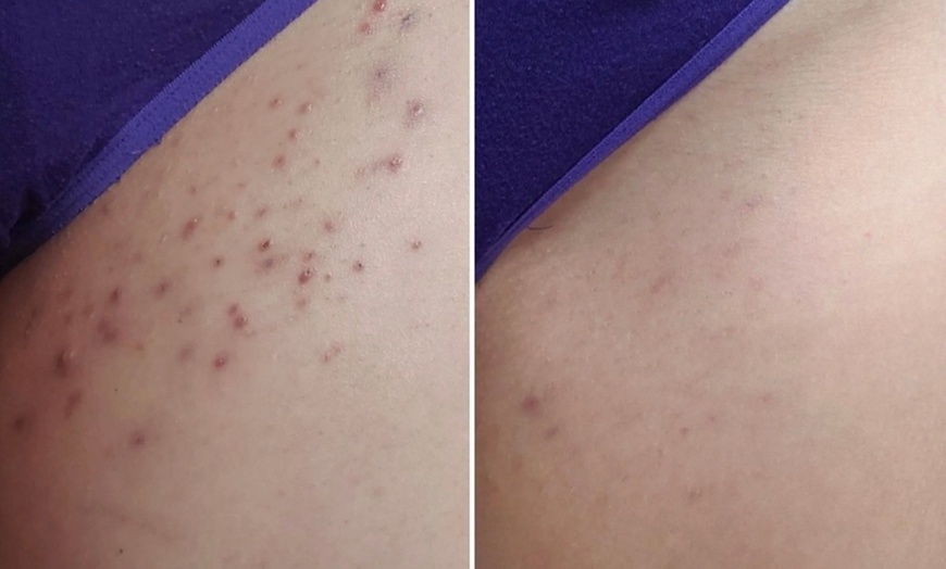 Image 3: One or Two Laser Skin Resurfacing Sessions for Full Face & More 