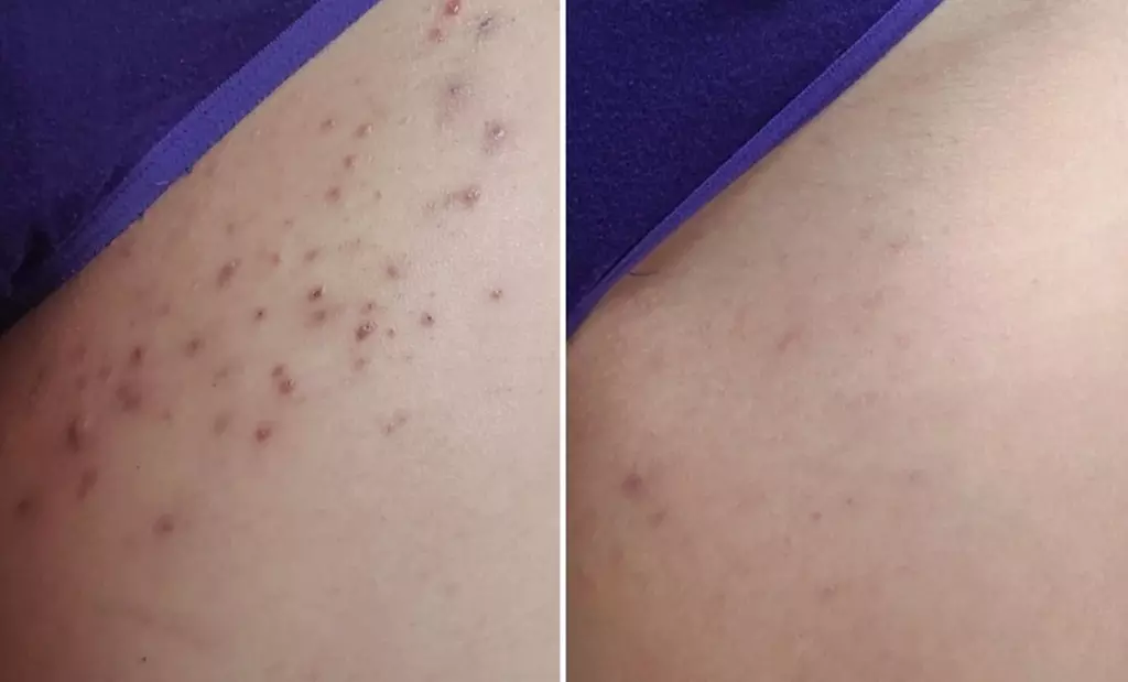 One or Two Laser Skin Resurfacing Sessions for Full Face & More 