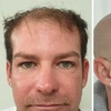 Image 1: Scalp Micropigmentation Hair-Loss Treatment - Crown, Front, or Filler